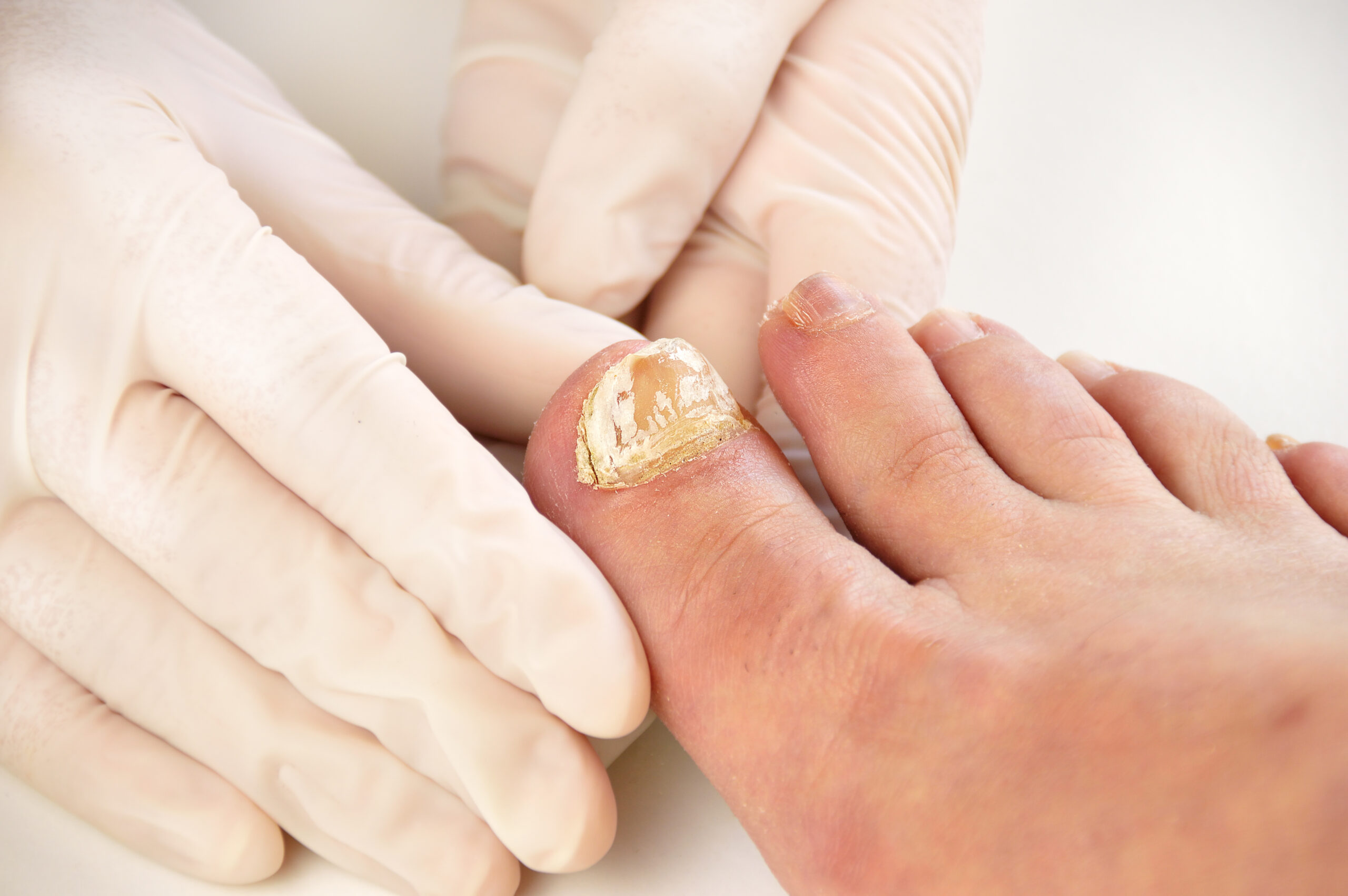 Closeup image of podologist examining the left foot toe nail suffering from fungus infection. horizontal studio picture on white background.