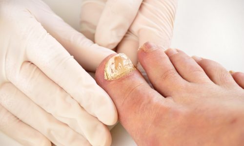 Closeup image of podologist examining the left foot toe nail suffering from fungus infection. horizontal studio picture on white background.