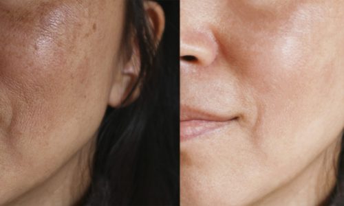 Before and after facial treatment concept. Face with melasma and brown spots and open pores.