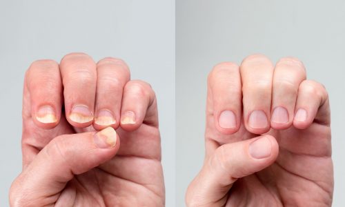 Before and after successful treatment for a onychomycosis or fungal nail infection on damaged nails after gel polish, onychosis. Longitudinal ridging nails with psoriasis, nail diseases
